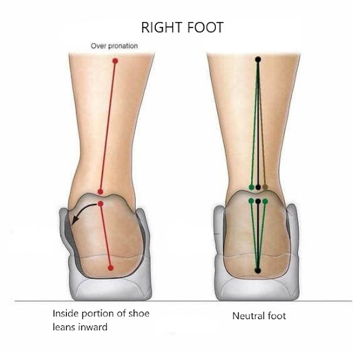 Diagram of a right foot: overpronation with the ankle rolling inward next to a neutral foot